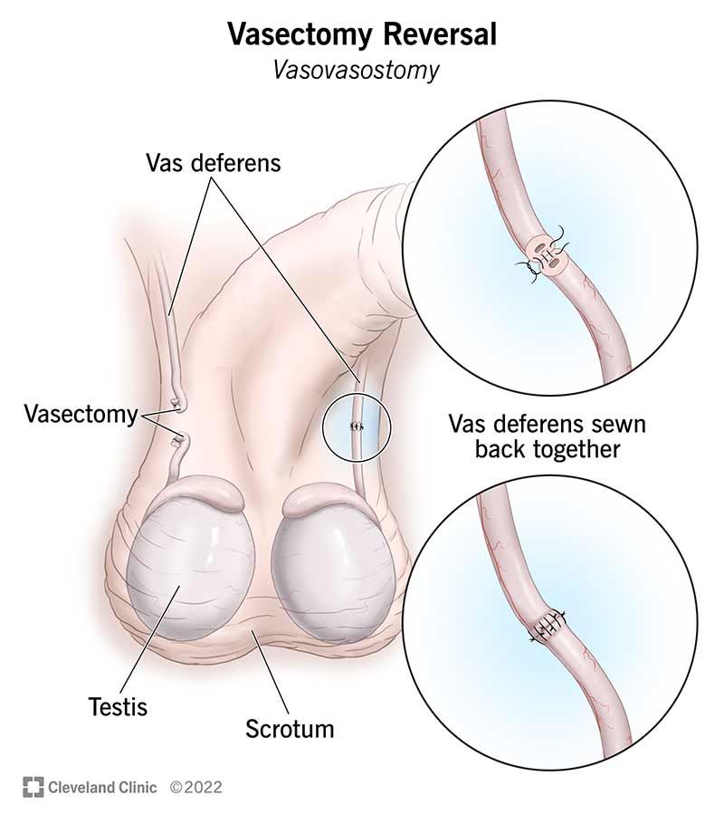 Vasectomy Reversal The Doctors Clinic